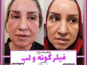 فیلر(ژل) گونه و لب