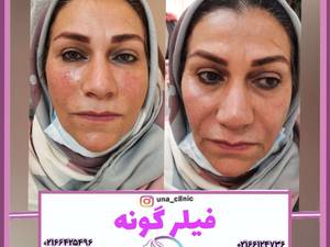 فیلر گونه