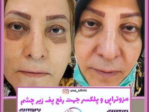 مزوتراپی و پلکسر زیر چشم