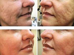 آر اف فرکشنال RF Fractional