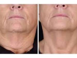 آر اف فرکشنال RF Fractional