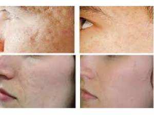 آر اف فرکشنال RF Fractional