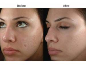 آر اف فرکشنال RF Fractional