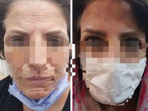 لیفت پیشانی بصورت حرفه ای در شیراز