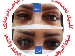 عمل پلک در شیراز
