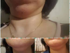 سوزاندن چربی های تجمع یافته با مزوتراپی