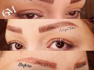 میکروبلیدینگ نرگس در رشت