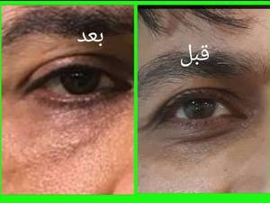 مزوتراپی چشم