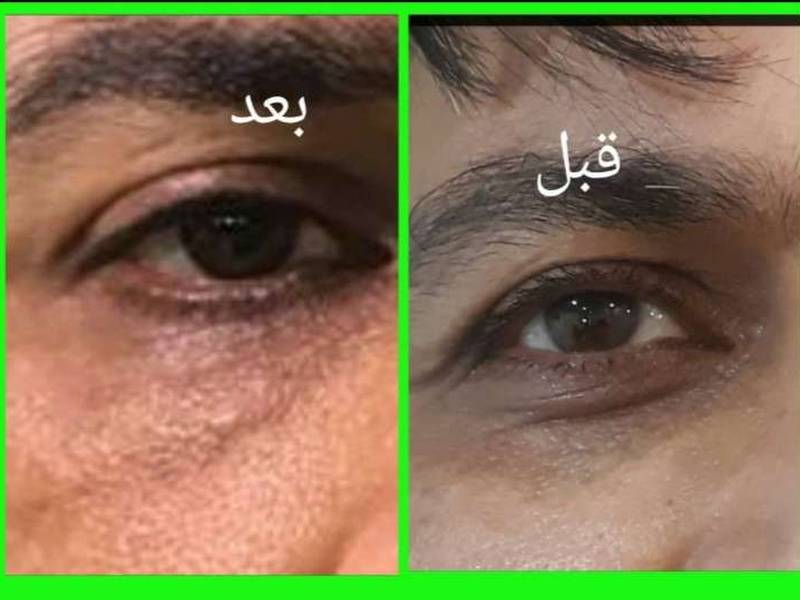 مزوتراپی چشم