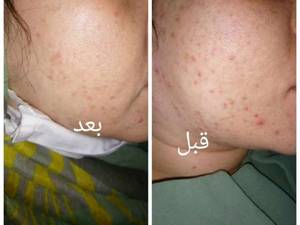رفع جوشهای صورت با دستگاه های فرکوئنسی