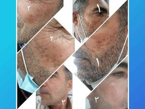 برطرف کردن جای جوش با مزوتراپی  در تهران