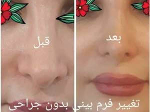 فرمدهی بینی بدون عمل جراحی در کلینیک زیبایی پریا