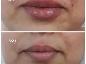 تزریق ژل برای  رفع چین و چروک‌ها در تهران
