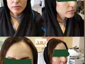 فیلر گونه  در شرق گیلان