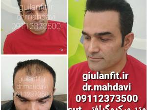 کلینیک کاشت مو گیلان فیت رشت_ دکتر مهدوی