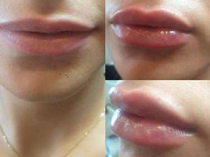 تزریق  طبیعی ژل لب