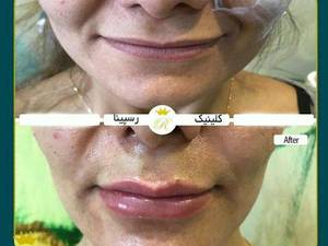 حجم دهی و فرم دهی لب