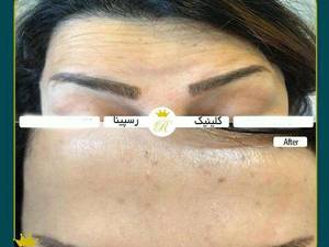 تزریق بوتاکس در شرق گیلان