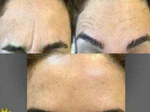 تزریق بوتاکس در لاهیجان