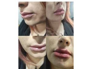 تزریق فقط یک سیسی ژل لب