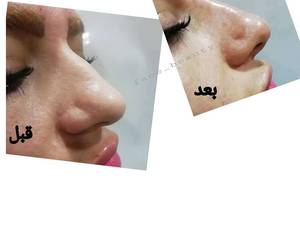 لیفت ورفع قوز بینی بدون عمل جراحی