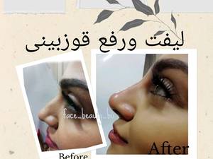 لیفت بینی بدون عمل جراحی در بوشهر