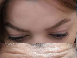 تزریق بوتاکس حرفه ای