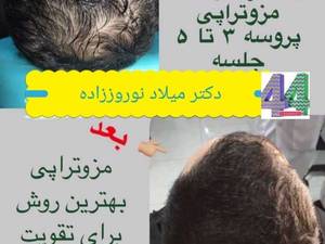 مزوتراپی مو برندهای معروف مزو