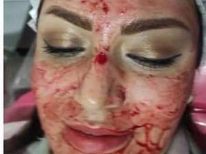 میکرونیدلینگ و مزونیدلینگ صورت