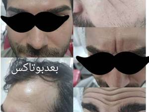 تزریق بوتاکس مصپورت