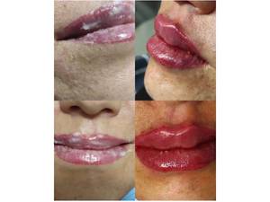 تزریق ژل لب به سبک روسی در کلنیک ۴۴