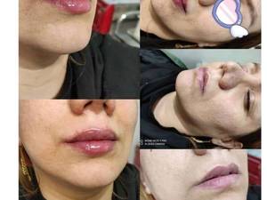 تزریق ژل لب به سبک روسی در کلنیک ۴۴