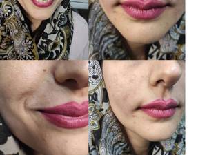 رفع خط خنده خط اندوه و خطوط سطحی