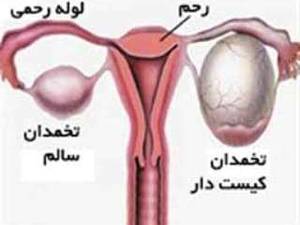 درمان کیست تخمدان با داروی گیاهی