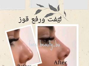 لیفت بینی بدون عمل در بوشهر