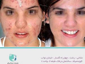 متد مزوتراپی