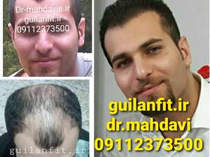 کلینیک کاشت مو گیلان فیت رشت دکترمهدوی