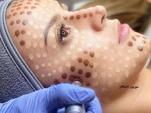 کرم پودر دائم با میکرونیدلینگ