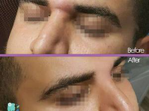 تزریق فیلر زیر چشم