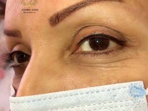 میکروبلیدینگ ستاره سیدی در رشت