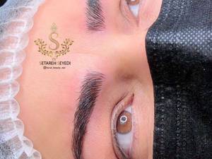 میکروبلیدینگ ستاره سیدی در رشت