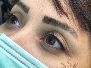 میکروبلیدینگ ستاره سیدی در رشت