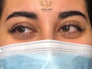 میکروبلیدینگ ستاره سیدی در رشت