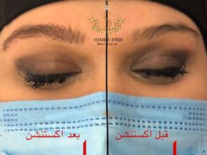 میکروبلیدینگ ستاره سیدی در رشت