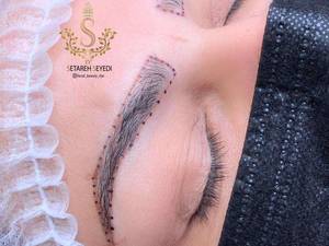 میکروبلیدینگ ستاره سیدی در رشت