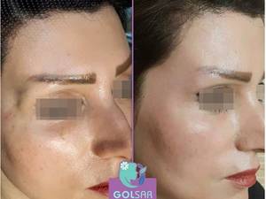 ‎تزریق گودی ناحیه کنارچشم