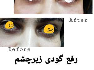 رفع گودی زیر چشم