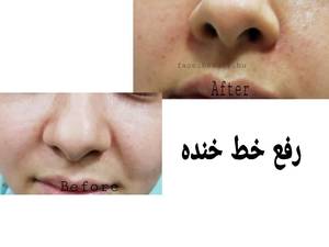 رفع خط خنده در بوشهر