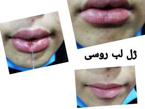 ژل لب روسی در بوشهر کلینیک_پوست_لیزر_بوشهر