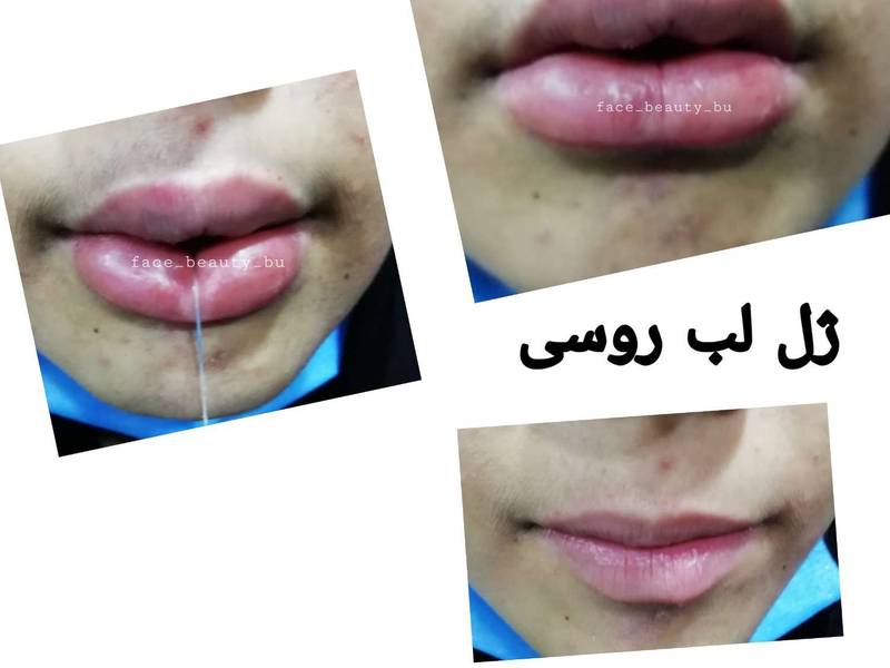 ژل لب روسی در بوشهر کلینیک_پوست_لیزر_بوشهر
